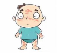 西宁如何治疗不同种类的荨麻疹