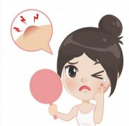 西宁治疗青春痘哪里好