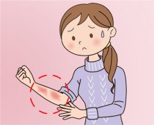 西宁荨麻疹专科医院